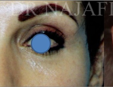 Blepharoplasty before and after - after