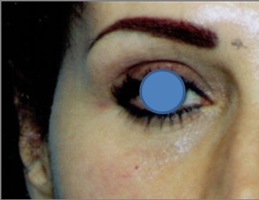 Blepharoplasty before and after - before