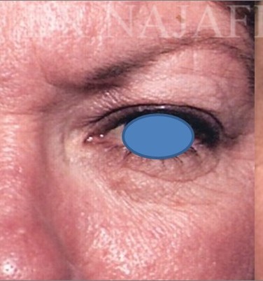 Blepharoplasty before and after - after