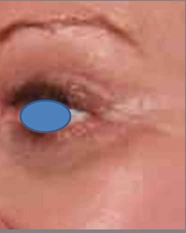 Blepharoplasty before and after - after