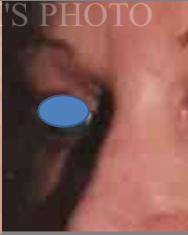 Blepharoplasty before and after - before