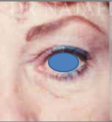 Blepharoplasty before and after - after