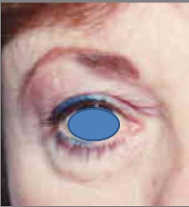 Blepharoplasty before and after - before
