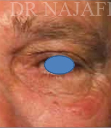 Blepharoplasty before and after - after
