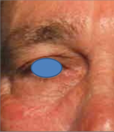Blepharoplasty before and after - before