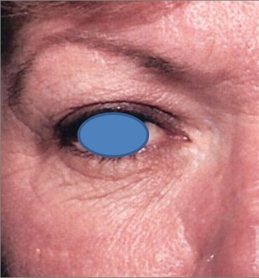 Blepharoplasty before and after - before