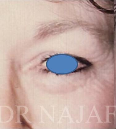 Blepharoplasty before and after - after