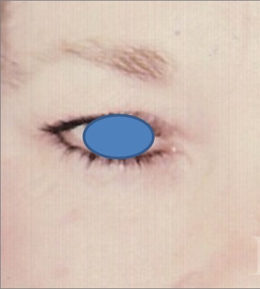 Blepharoplasty before and after - before