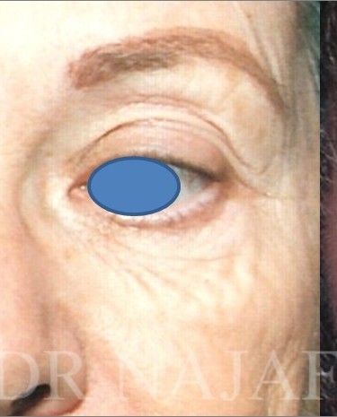 Blepharoplasty before and after - after