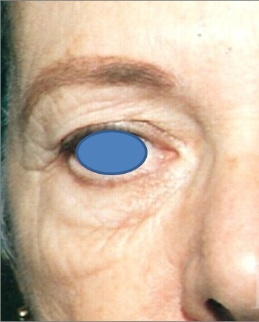 Blepharoplasty before and after - before