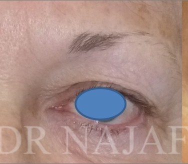 Blepharoplasty before and after - after