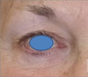 Blepharoplasty before and after - before
