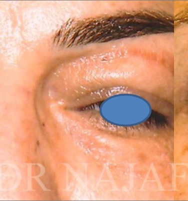 Blepharoplasty before and after - after