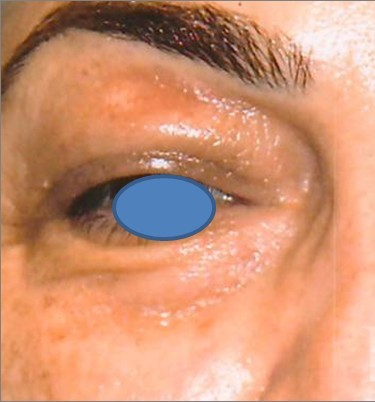 Blepharoplasty before and after - before