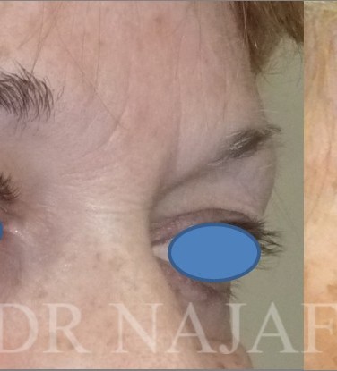 Blepharoplasty before and after - after