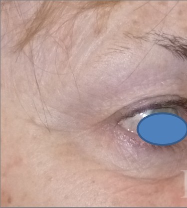 Blepharoplasty before and after - before