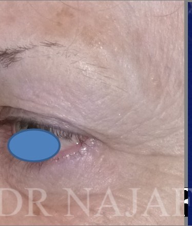 Blepharoplasty before and after - after