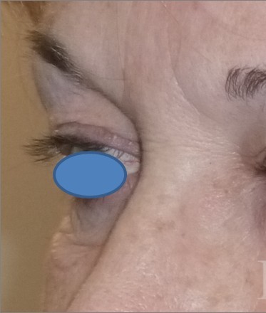 Blepharoplasty before and after - before