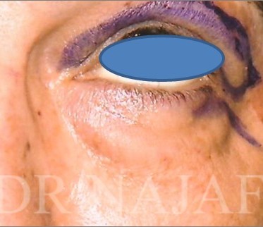 Blepharoplasty before and after - after