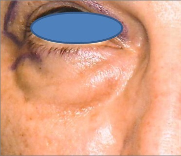 Blepharoplasty before and after - before