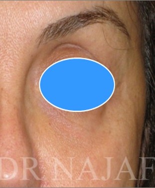 Blepharoplasty before and after - after