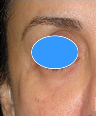 Blepharoplasty before and after - before