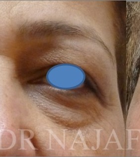 Blepharoplasty before and after - after
