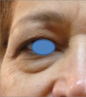 Blepharoplasty before and after - before