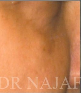 Blepharoplasty before and after - after
