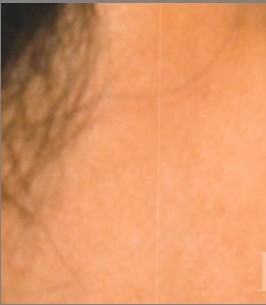 Blepharoplasty before and after - before