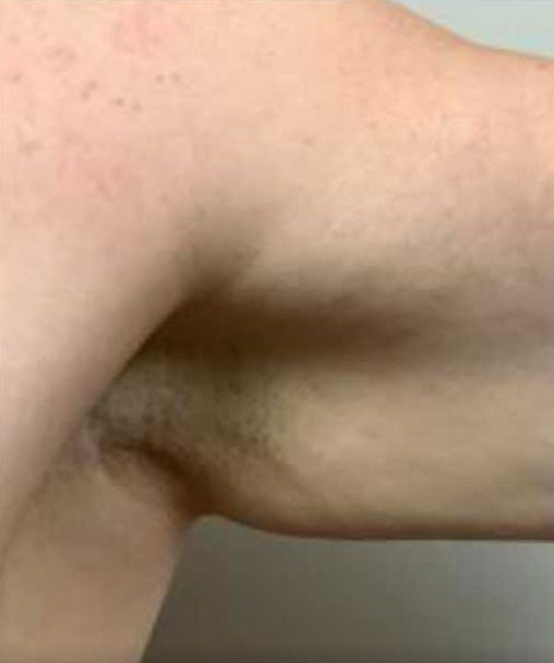 Arm Lift before and after - before