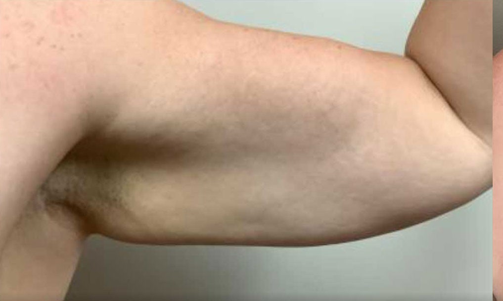 Arm Lift before — Dr. Stephen Coccaro