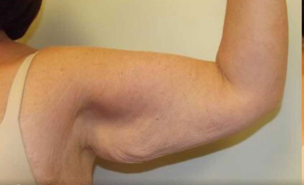 Arm Lift before — Dr. Stephen Coccaro