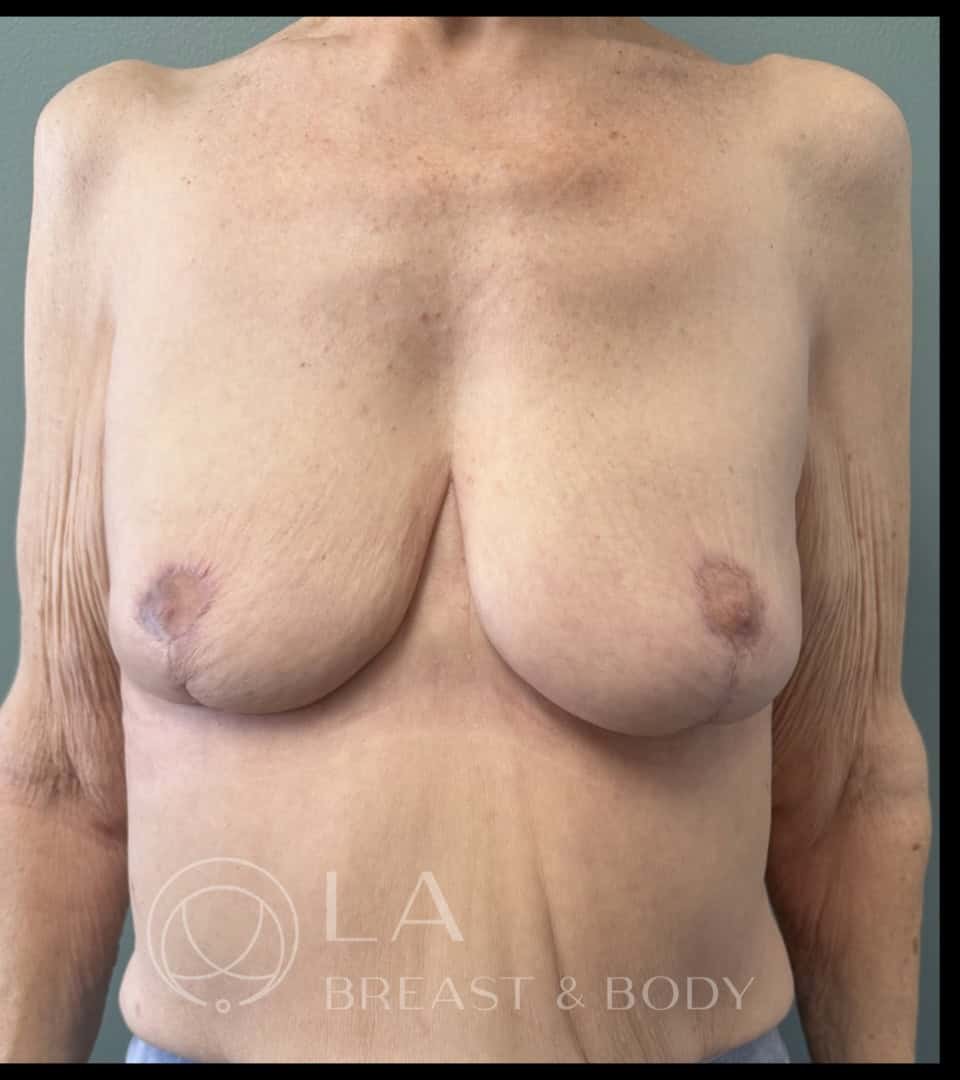 Mastopexy with Auto-Augmentation before and after - after