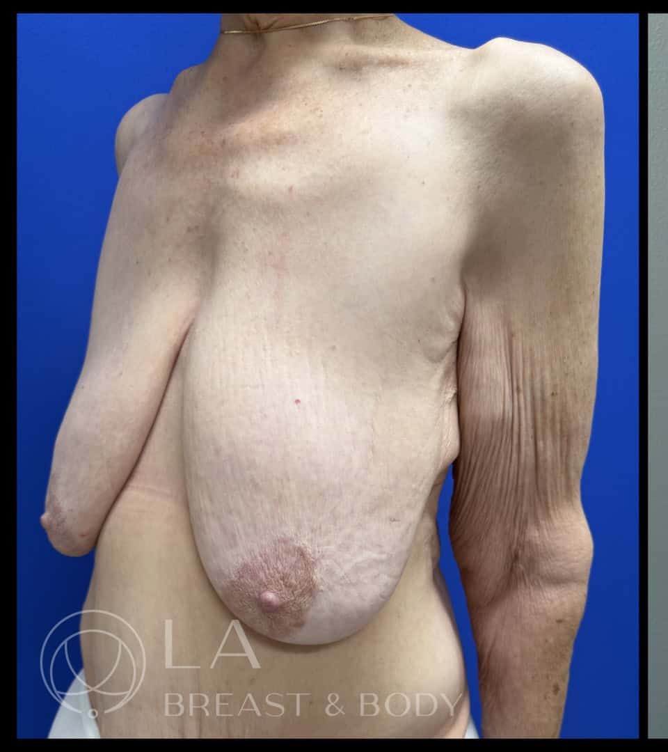 Mastopexy with Auto-Augmentation before and after - before