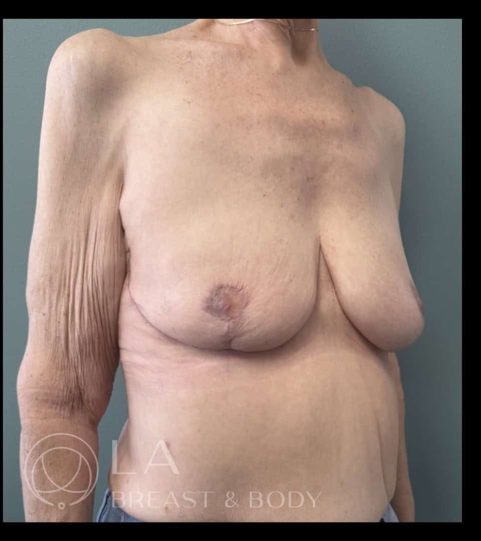 Mastopexy with Auto-Augmentation before and after - after