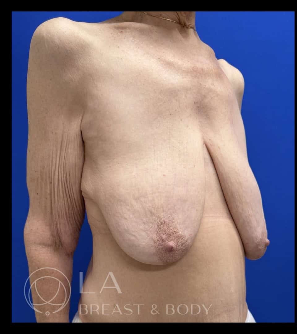 Mastopexy with Auto-Augmentation before and after - before