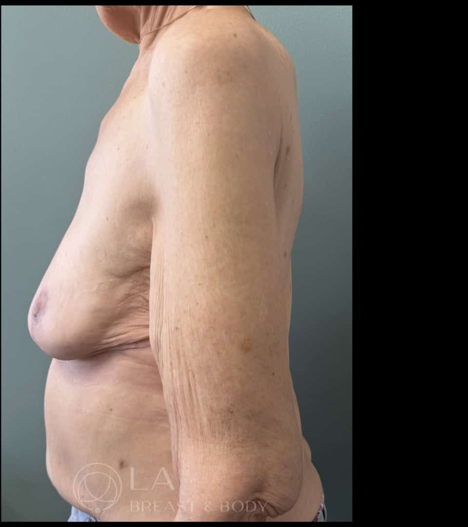 Mastopexy with Auto-Augmentation before and after - after