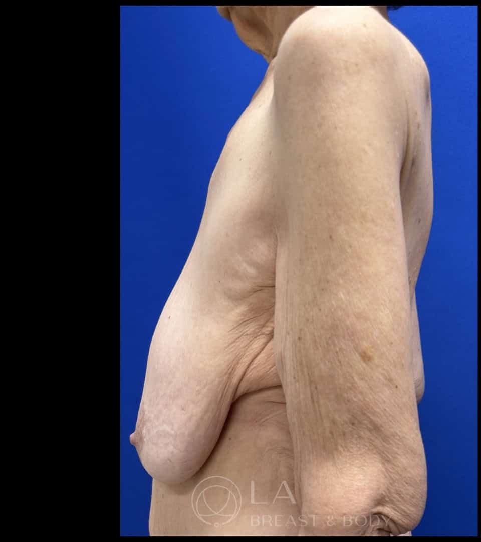 Mastopexy with Auto-Augmentation before and after - before
