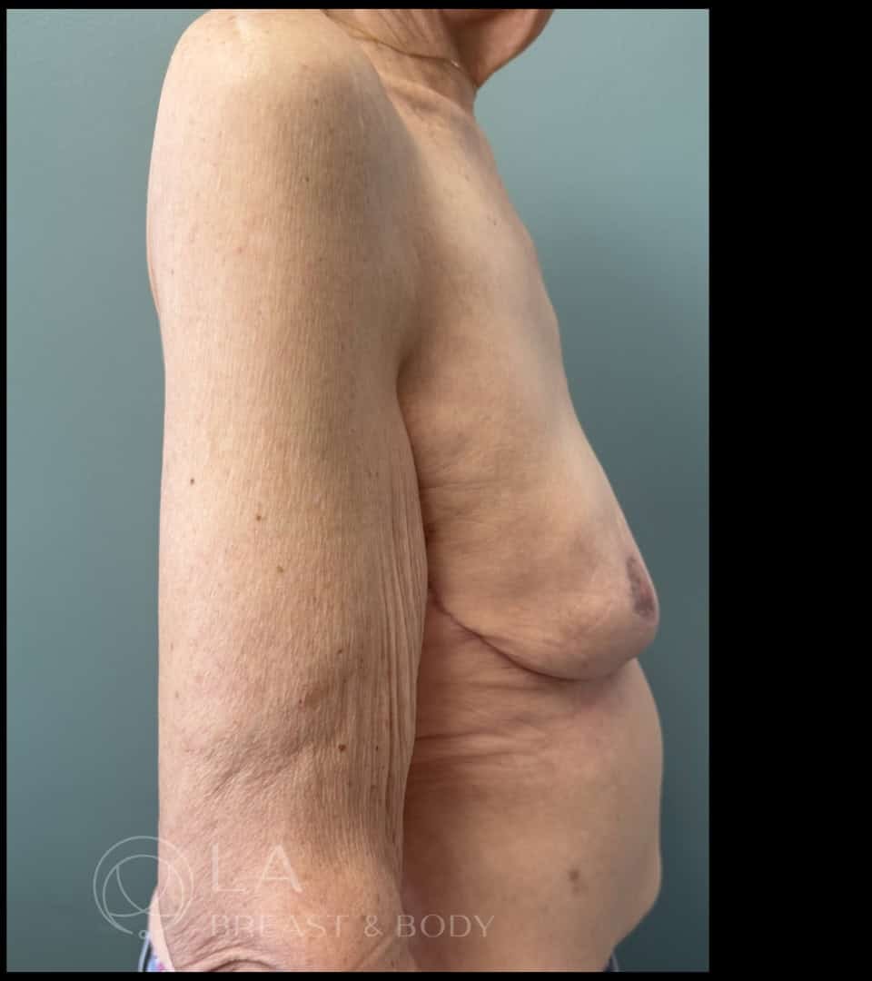 Mastopexy with Auto-Augmentation before and after - after