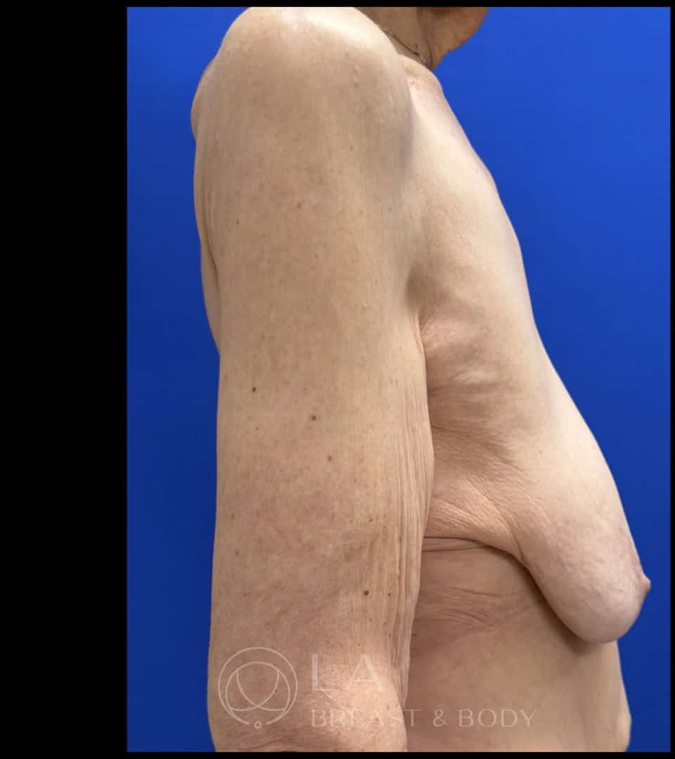 Mastopexy with Auto-Augmentation before and after - before