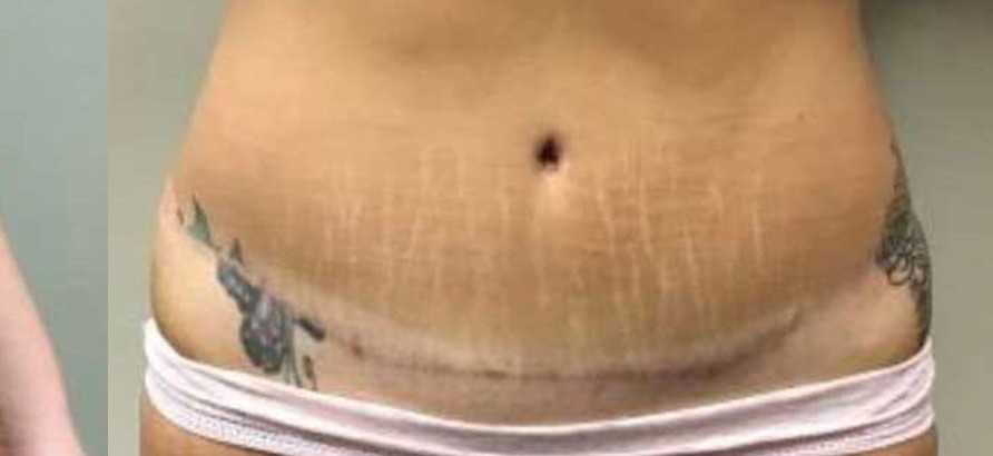 Abdominoplasty before and after - after