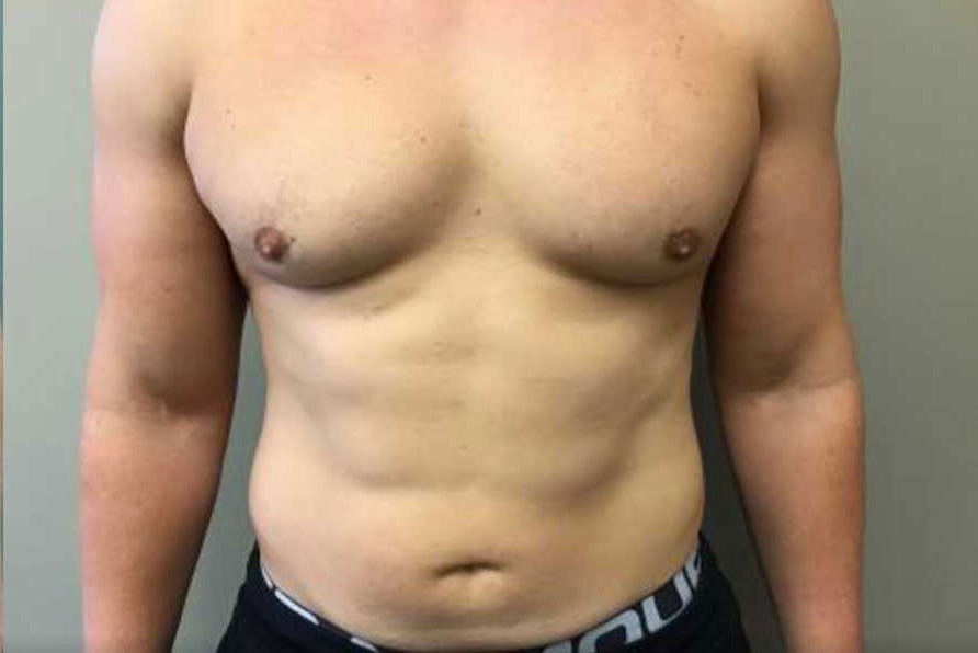 Liposuction before and after - after