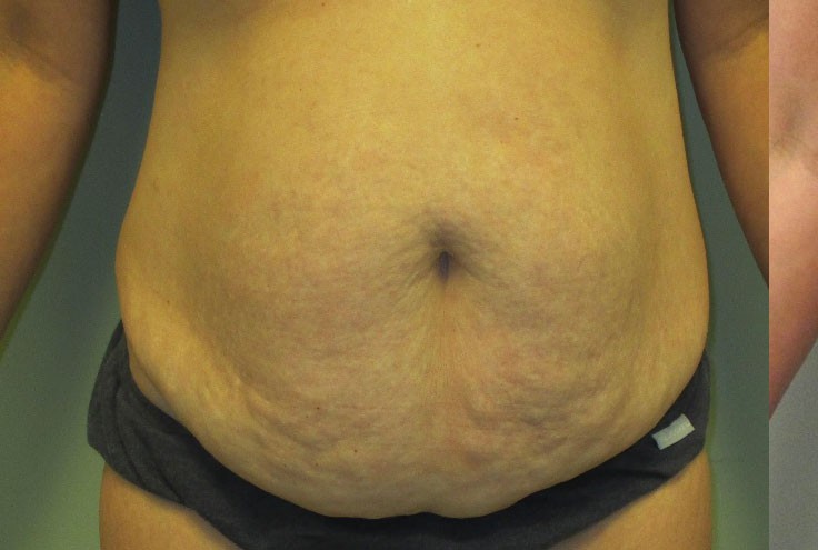 Abdominoplasty before and after - before
