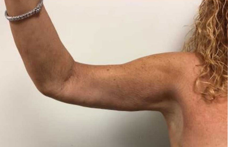 Arm Lift after — Dr. Hilton Adler