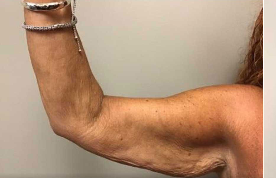 Arm Lift before — Dr. Hilton Adler