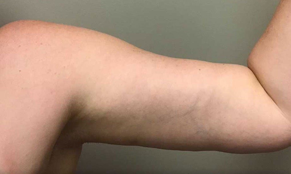 Arm Lift after — Dr. Hilton Adler