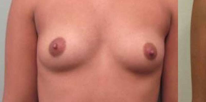 Breast Augmentation before and after - before