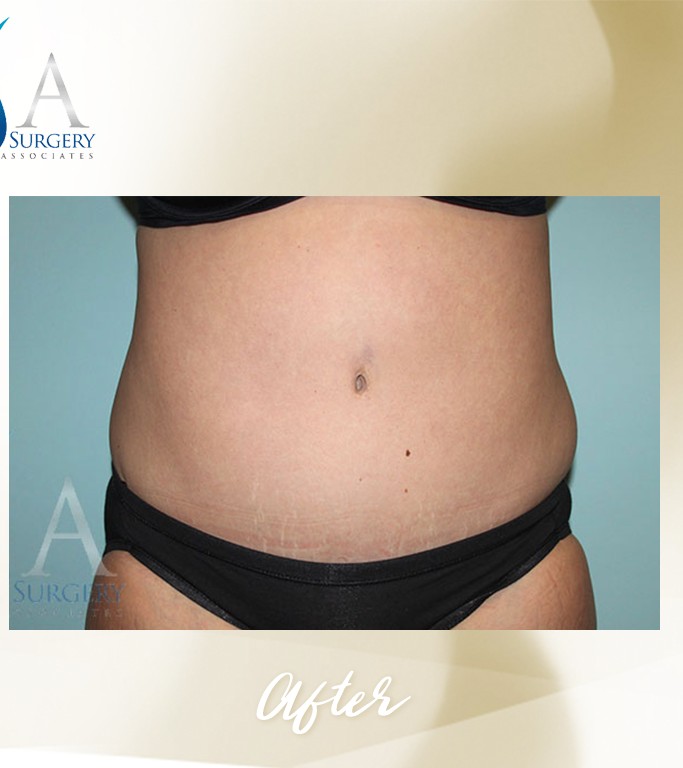 Abdominoplasty before and after - after