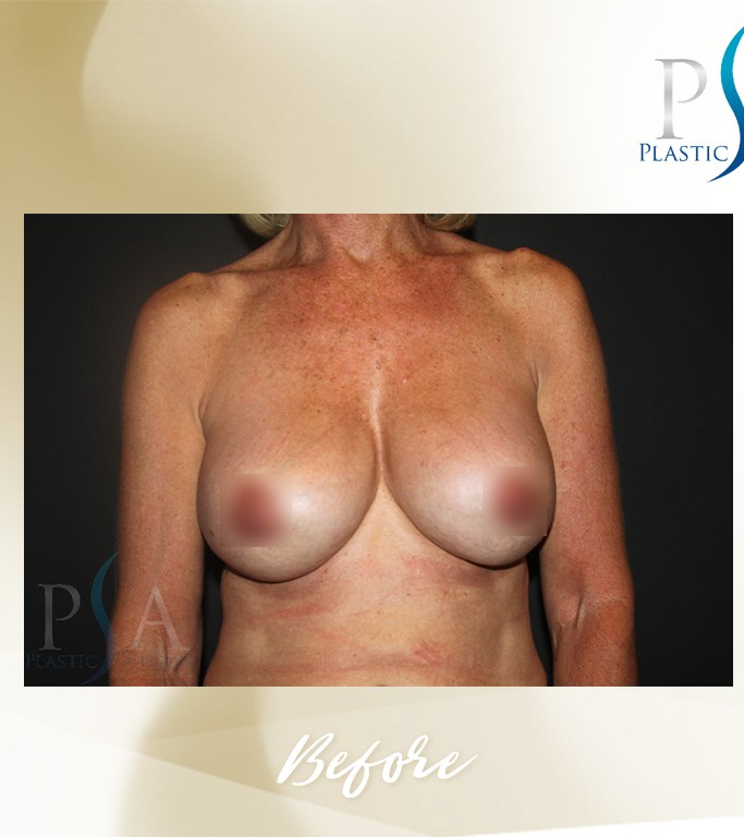 Corrective Breast Surgeries before and after - before
